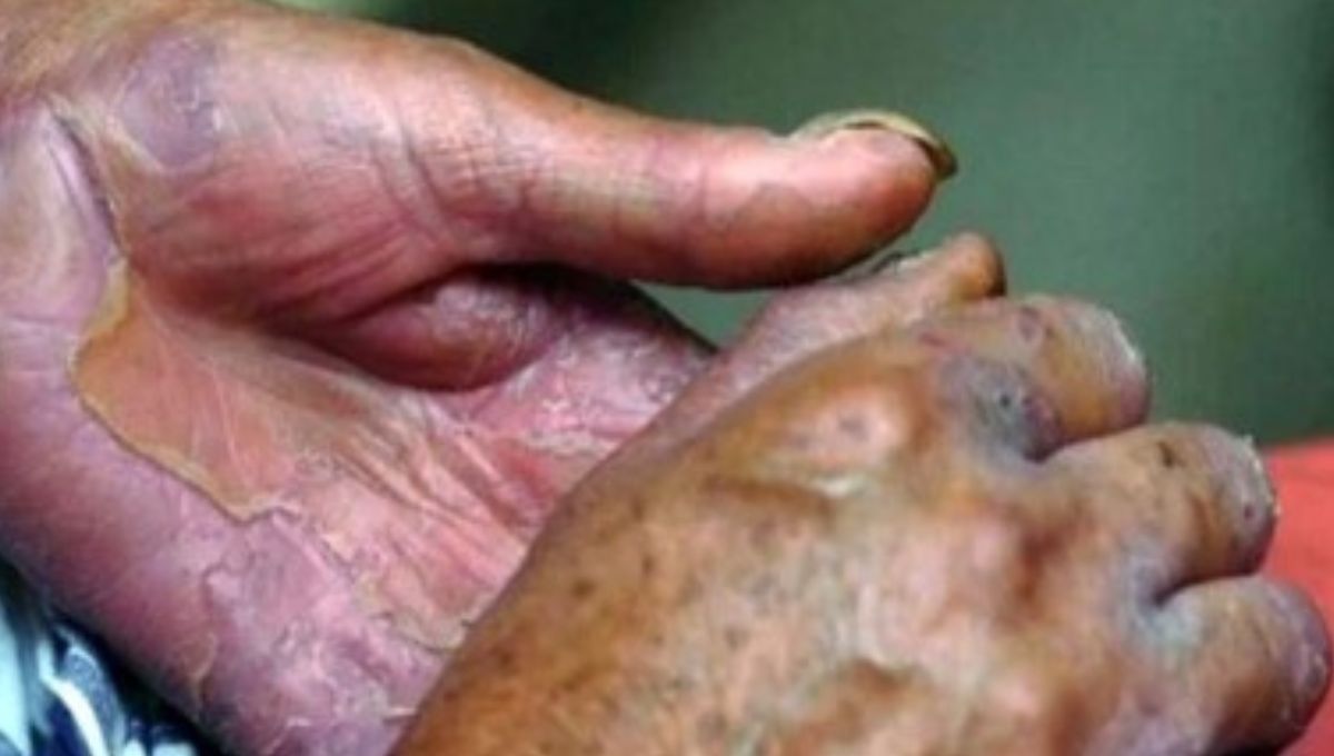 Alerta sanitaria en México: ¿Qué es la lepra y cómo se contagia?