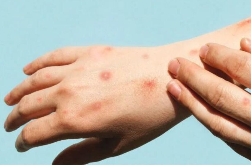 ¿Qué es el Mpox? Síntomas y lo que hay que saber de la viruela del mono