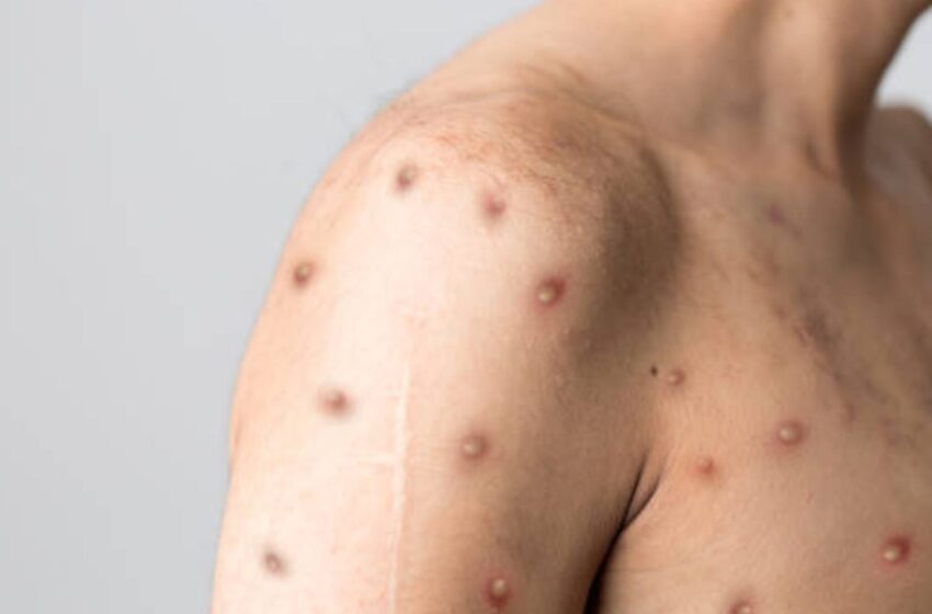SSA emite aviso epidemiológico por emergencia de salud internacional por mpox