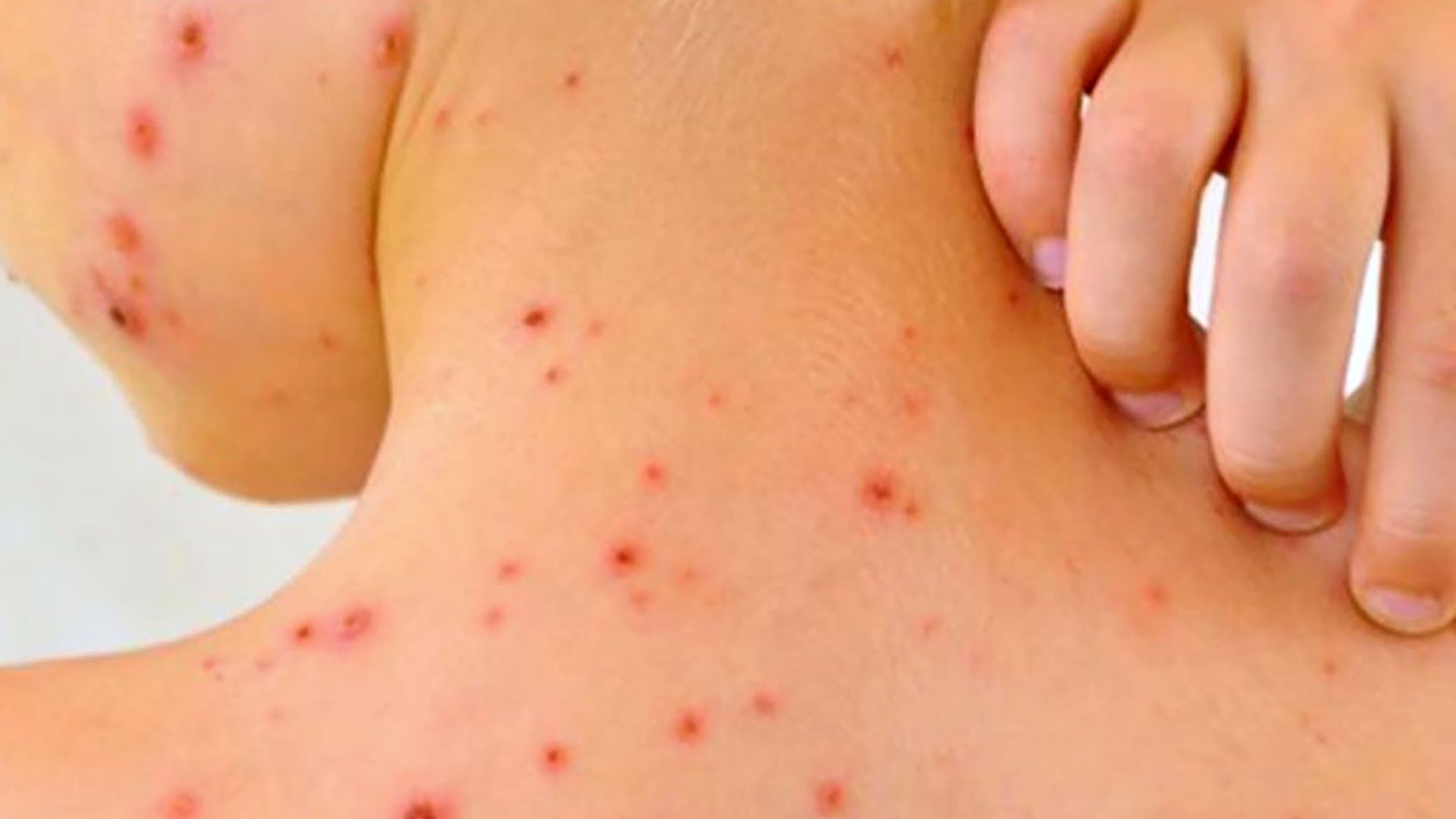 México en riesgo de perder su estatus de país libre de sarampión